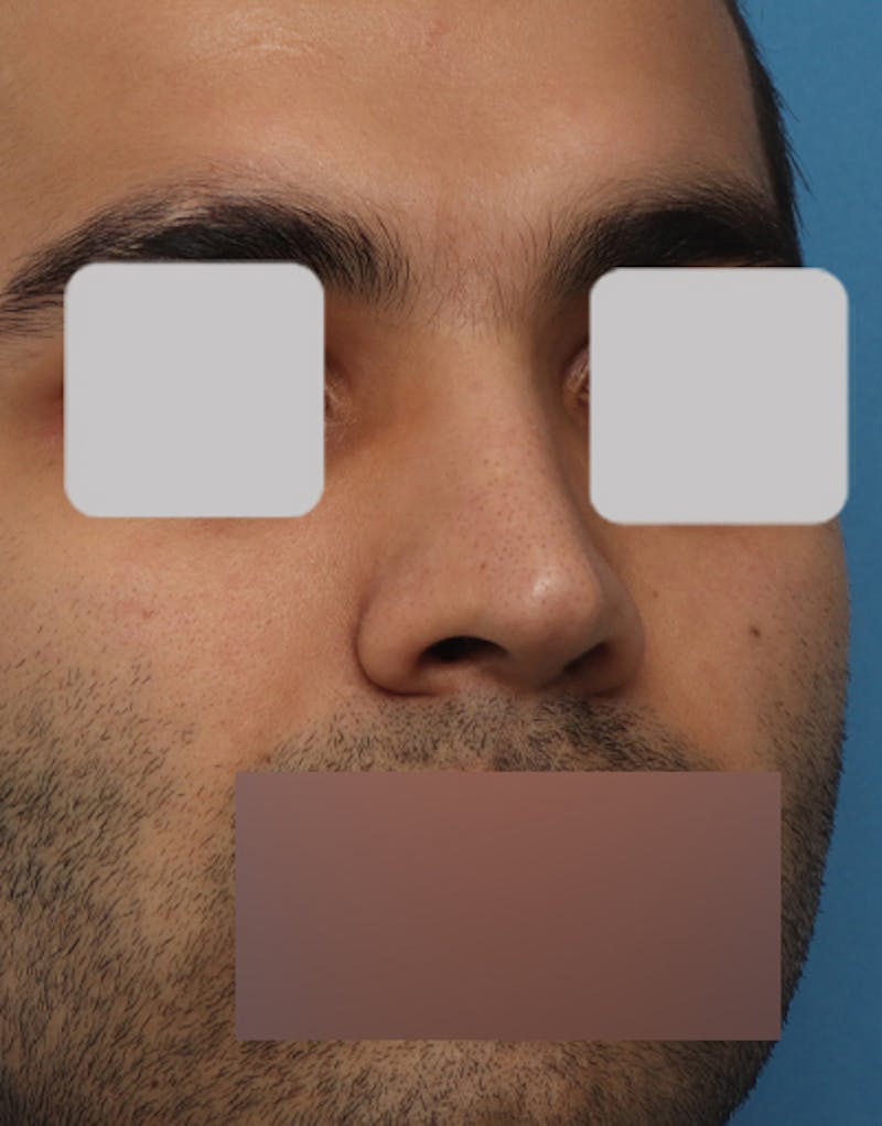 Rhinoplasty  Before & After Gallery - Patient 366683 - Image 4