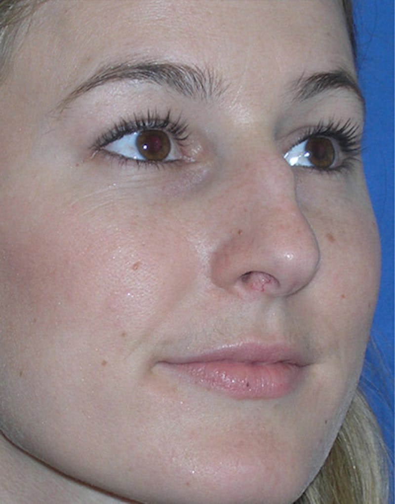 Rhinoplasty Before & After Gallery - Patient 101069 - Image 5