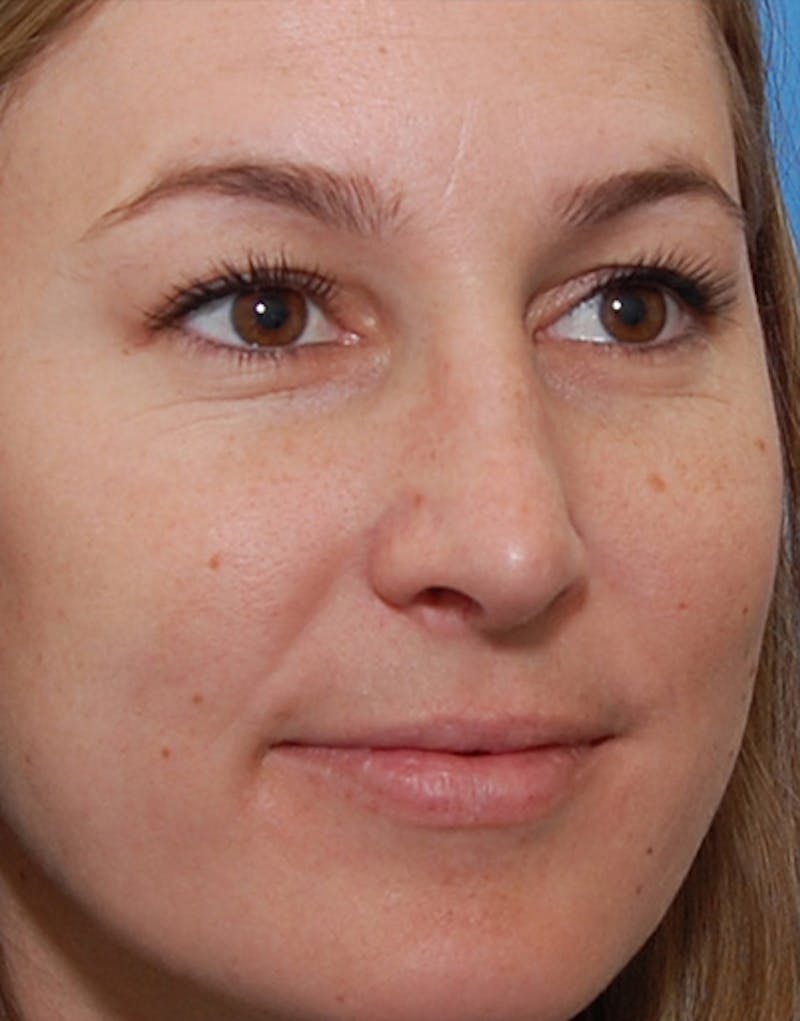 Rhinoplasty Before & After Gallery - Patient 101069 - Image 6