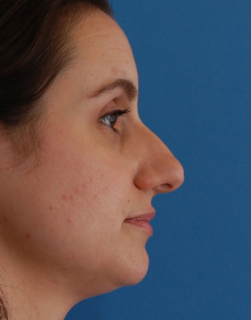Rhinoplasty Before & After Gallery - Patient 282002 - Image 1