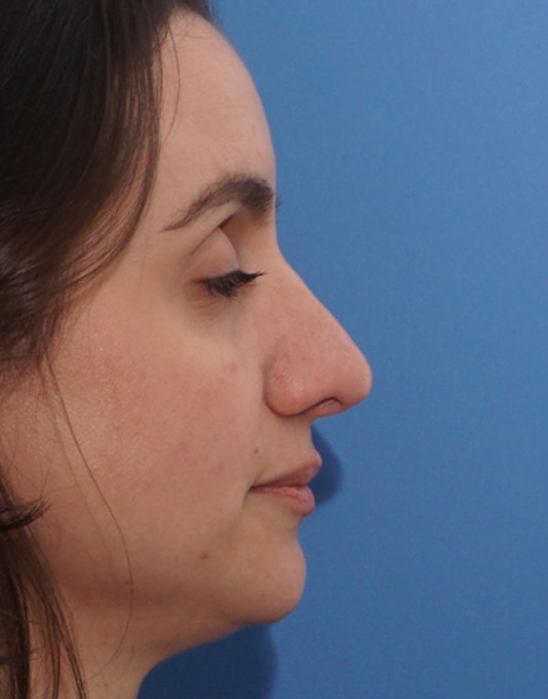 Rhinoplasty Before & After Gallery - Patient 282002 - Image 2