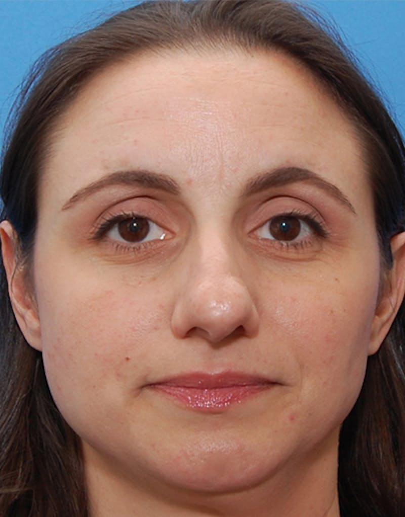 Rhinoplasty Before & After Gallery - Patient 282002 - Image 3