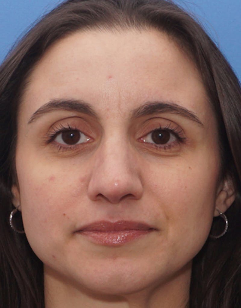 Rhinoplasty  Before & After Gallery - Patient 174565 - Image 4