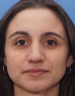 Rhinoplasty Before & After Gallery - Patient 174565 - Image 4