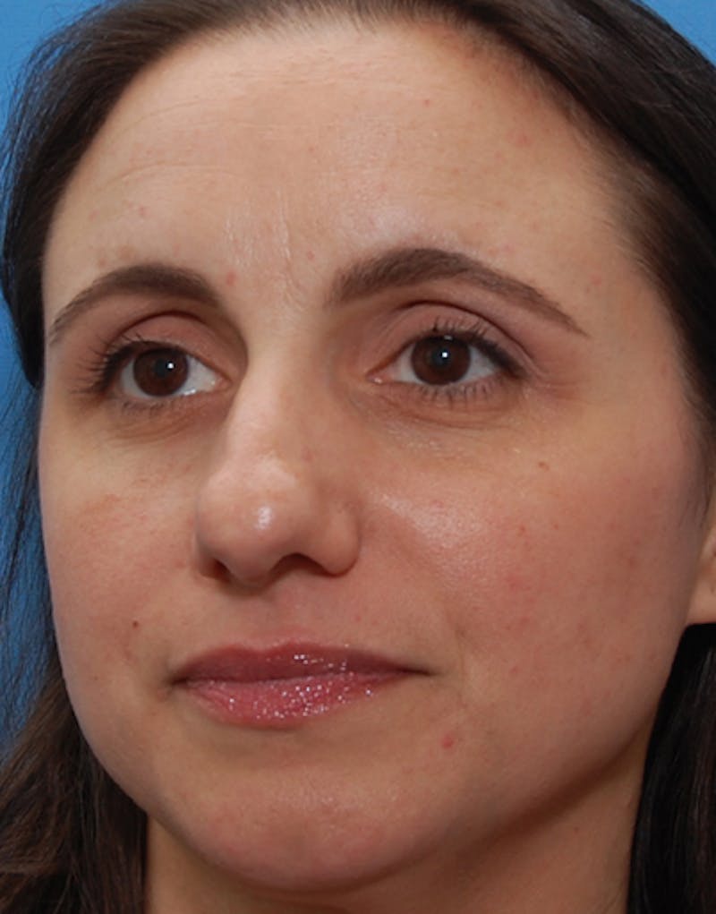 Rhinoplasty  Before & After Gallery - Patient 174565 - Image 5