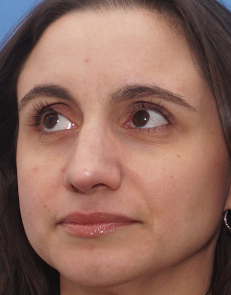 Rhinoplasty  Before & After Gallery - Patient 174565 - Image 6