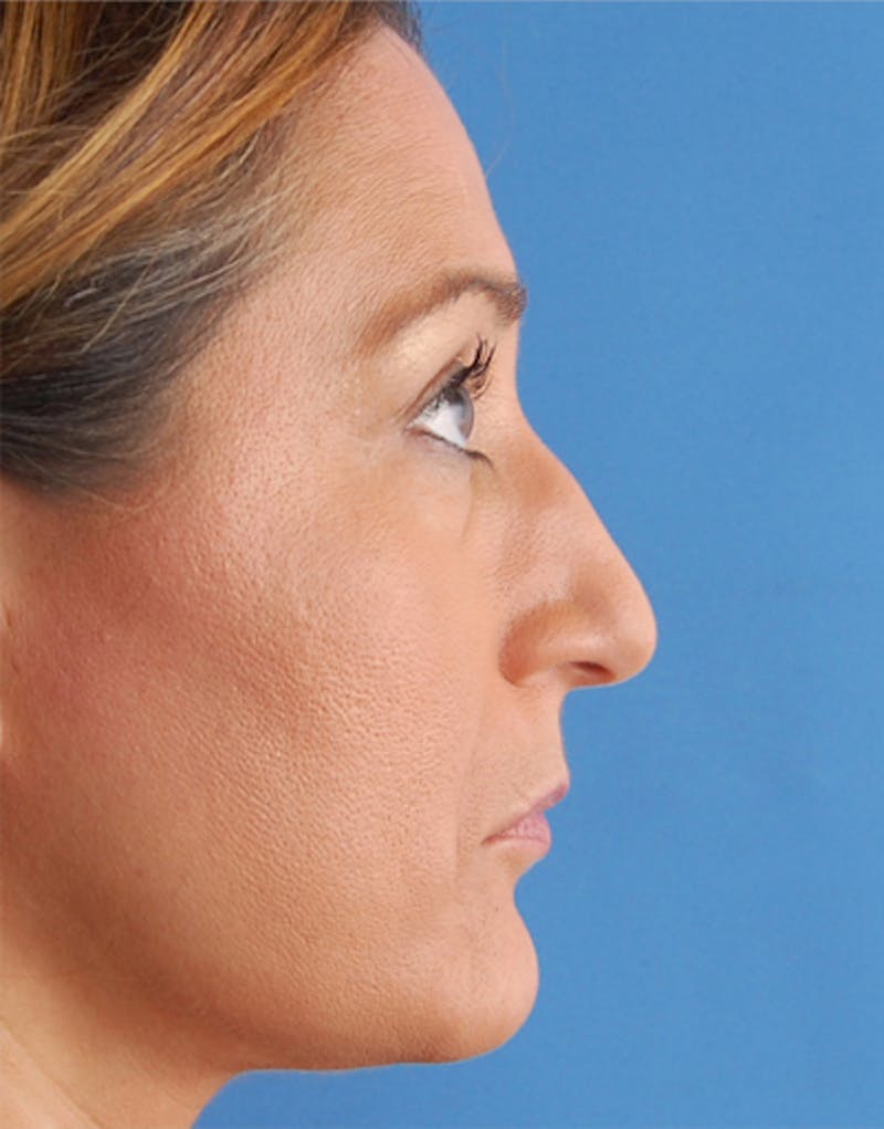 Rhinoplasty Before & After Gallery - Patient 139133 - Image 1
