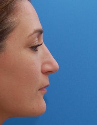 Rhinoplasty Before & After Gallery - Patient 367423 - Image 2