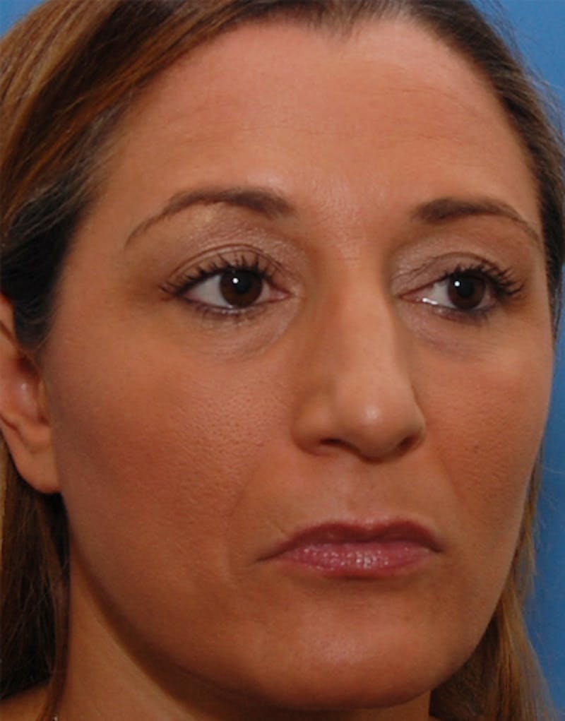 Rhinoplasty  Before & After Gallery - Patient 367423 - Image 5