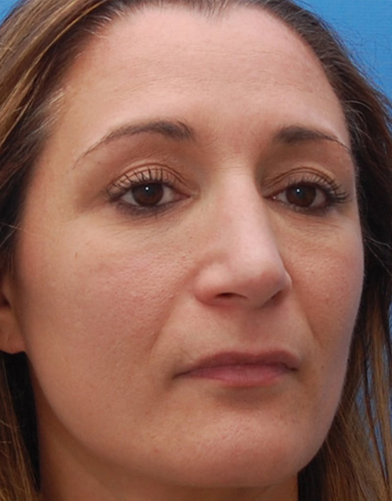Rhinoplasty  Before & After Gallery - Patient 367423 - Image 6