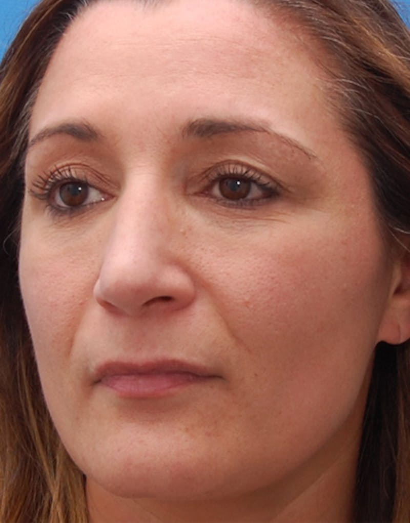 Rhinoplasty  Before & After Gallery - Patient 367423 - Image 8
