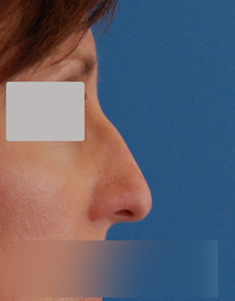 Rhinoplasty Before & After Gallery - Patient 264855 - Image 1