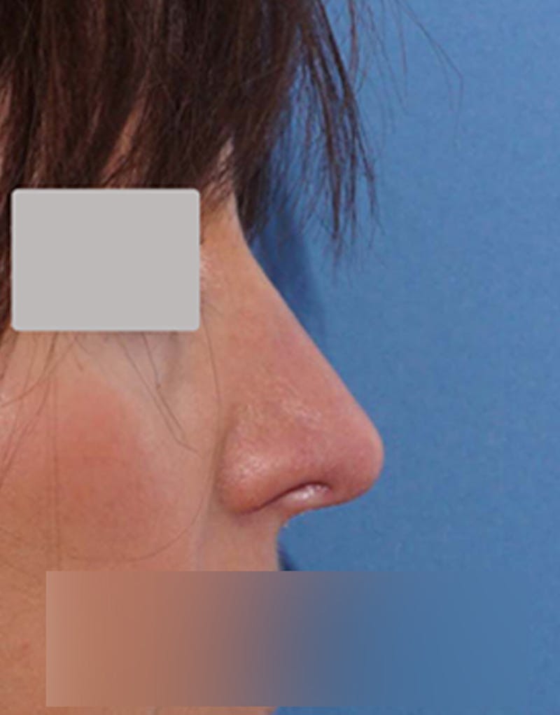 Rhinoplasty Before & After Gallery - Patient 264855 - Image 2
