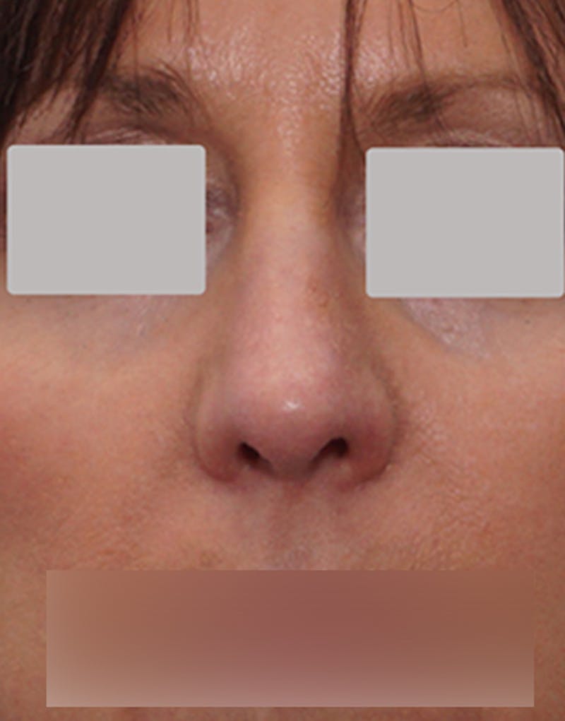 Rhinoplasty Before & After Gallery - Patient 264855 - Image 4