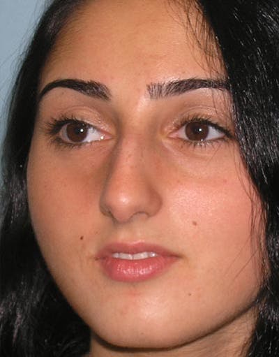 Rhinoplasty Before & After Gallery - Patient 585456 - Image 1