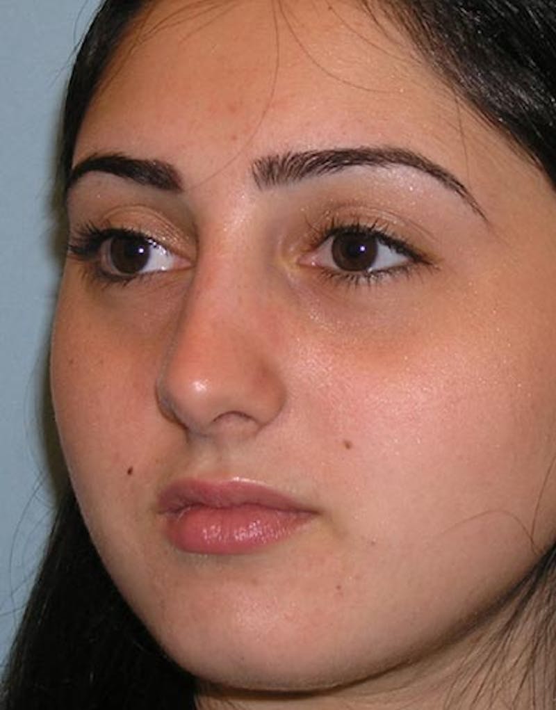 Rhinoplasty Before & After Gallery - Patient 264855 - Image 6
