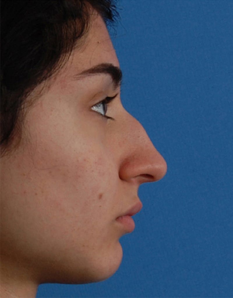 Rhinoplasty Before & After Gallery - Patient 711535 - Image 1