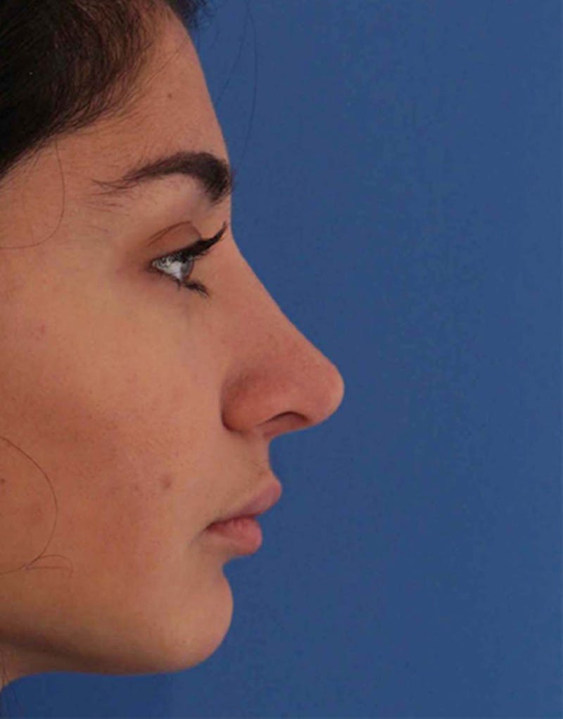 Rhinoplasty Before & After Gallery - Patient 711535 - Image 2