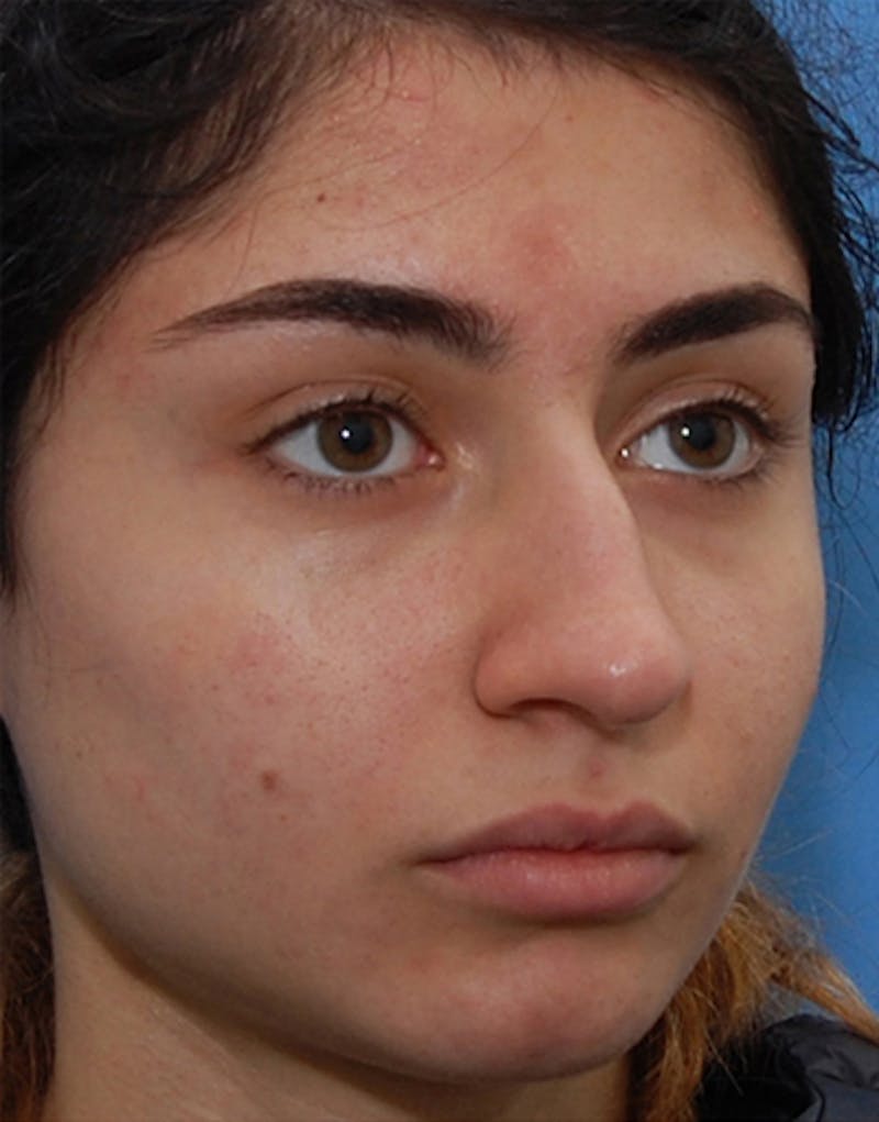 Rhinoplasty Before & After Gallery - Patient 711535 - Image 3