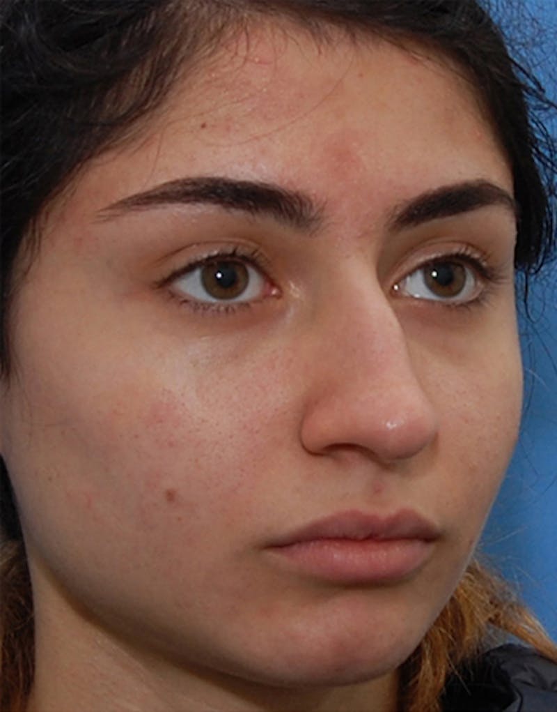 Rhinoplasty  Before & After Gallery - Patient 131292 - Image 3
