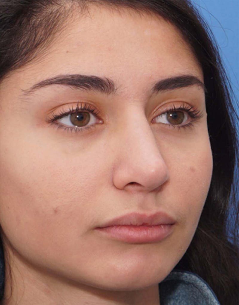 Rhinoplasty Before & After Gallery - Patient 711535 - Image 4