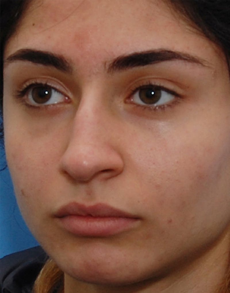 Rhinoplasty Before & After Gallery - Patient 711535 - Image 5