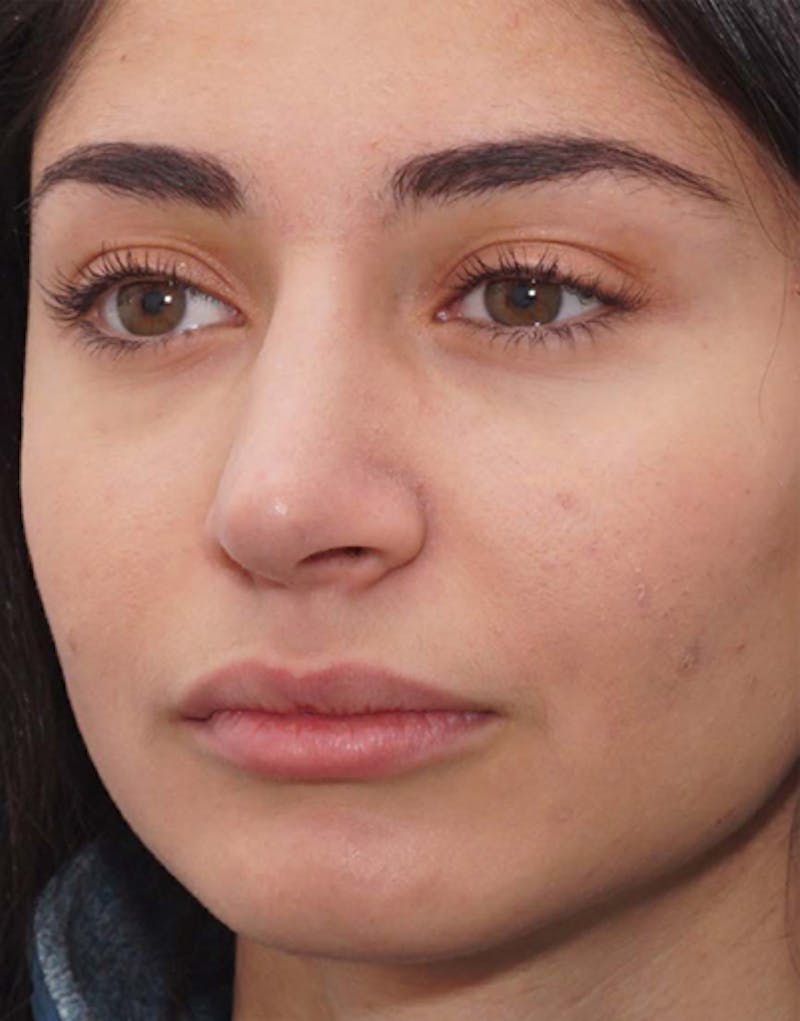 Rhinoplasty Before & After Gallery - Patient 711535 - Image 6