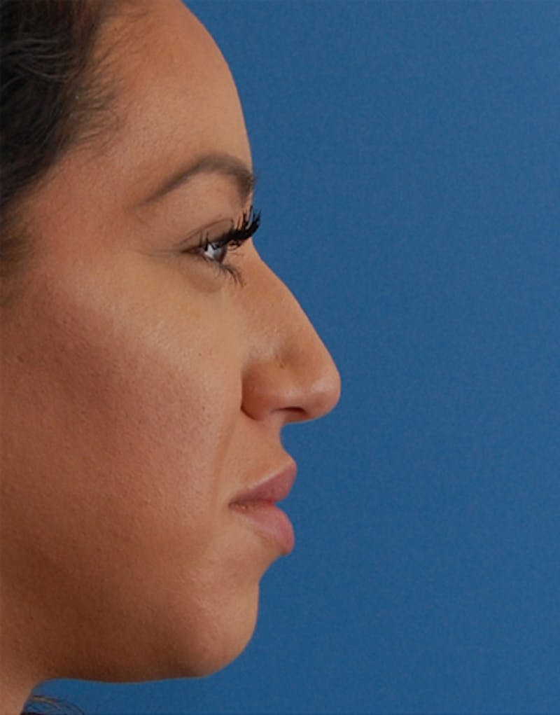 Rhinoplasty Before & After Gallery - Patient 124827 - Image 1