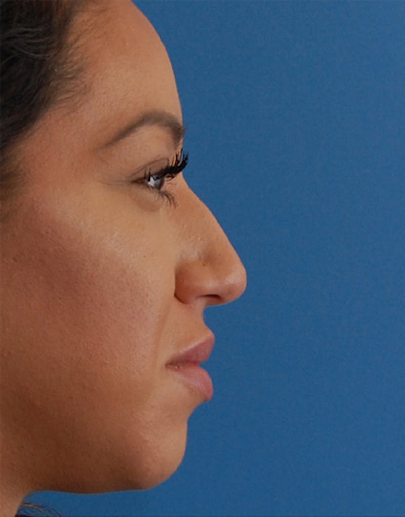 Patient U78puaeeQYm2GvFsEtLTLA - Rhinoplasty Before & After Photos