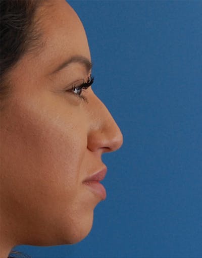 Favorite Ethnic Rhinoplasty Before & After Gallery - Patient 118498 - Image 1