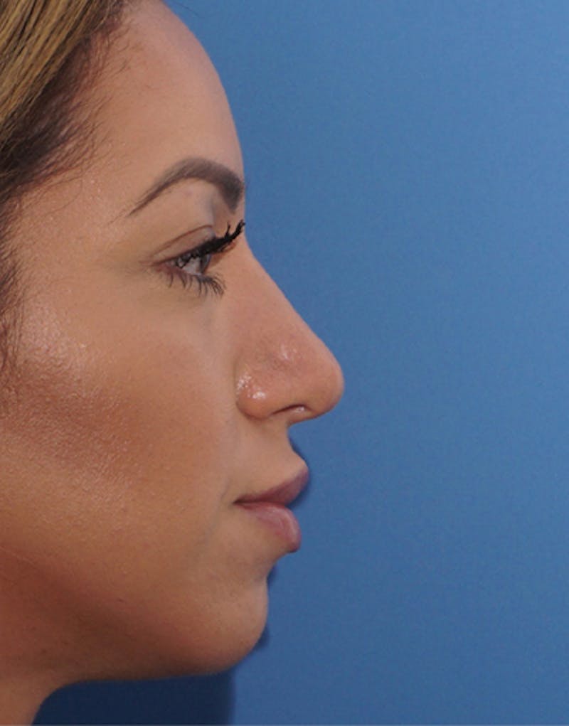 Rhinoplasty Before & After Gallery - Patient 124827 - Image 2