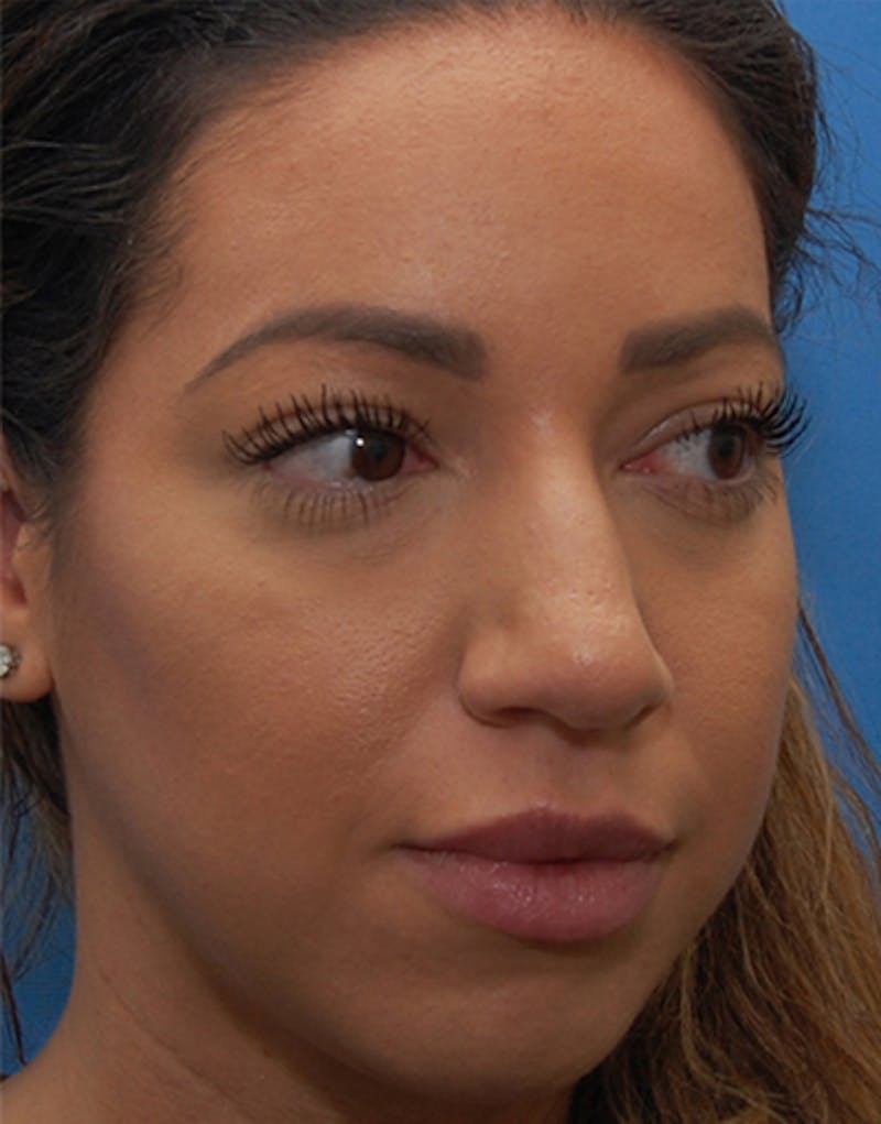 Favorite Ethnic Rhinoplasty Before & After Gallery - Patient 118498 - Image 5
