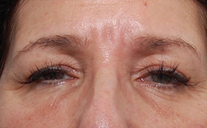 Brow Lift Before & After Gallery - Patient 104505 - Image 1