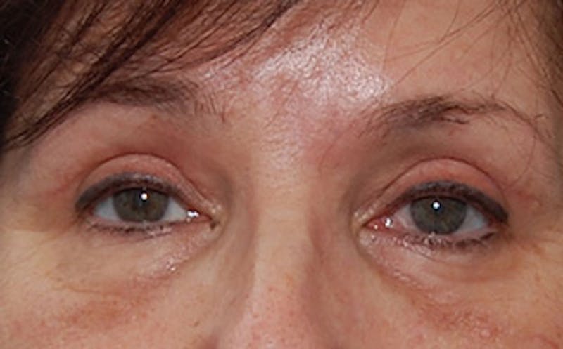 Brow Lift Before & After Gallery - Patient 104505 - Image 2