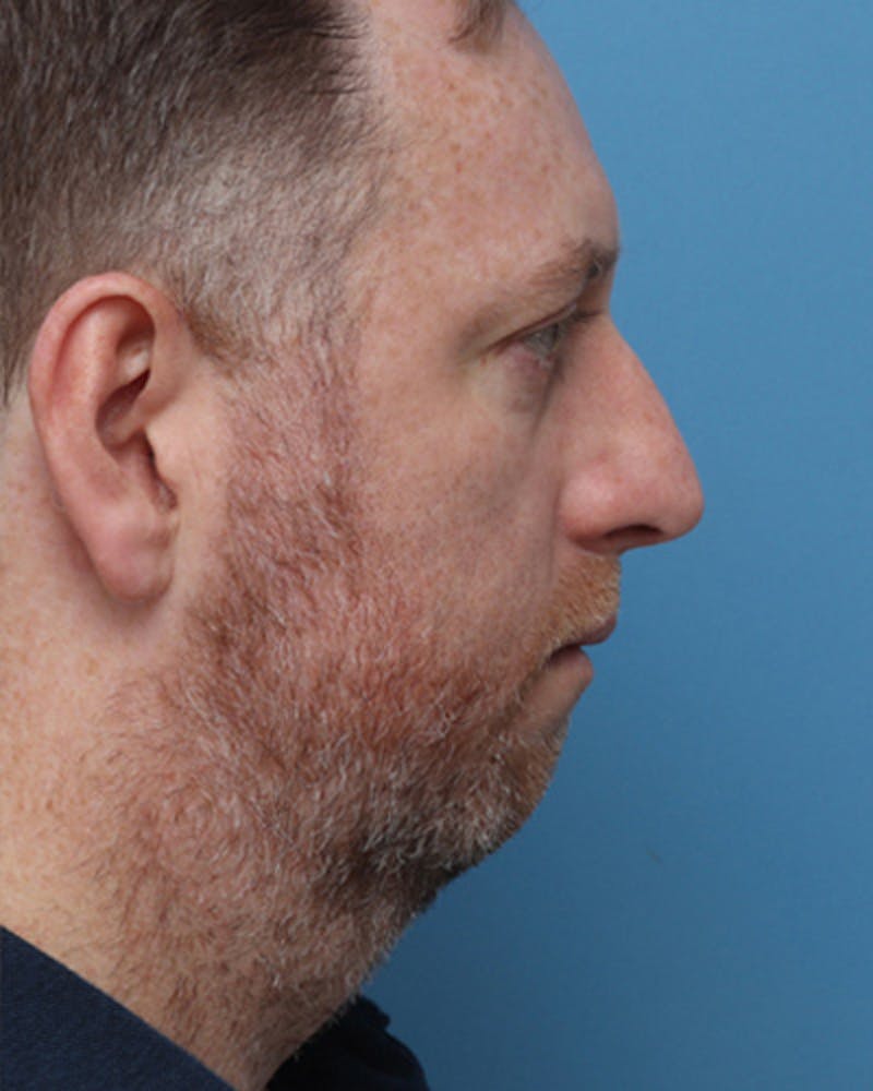 Chin Surgery Before & After Gallery - Patient 261927 - Image 1