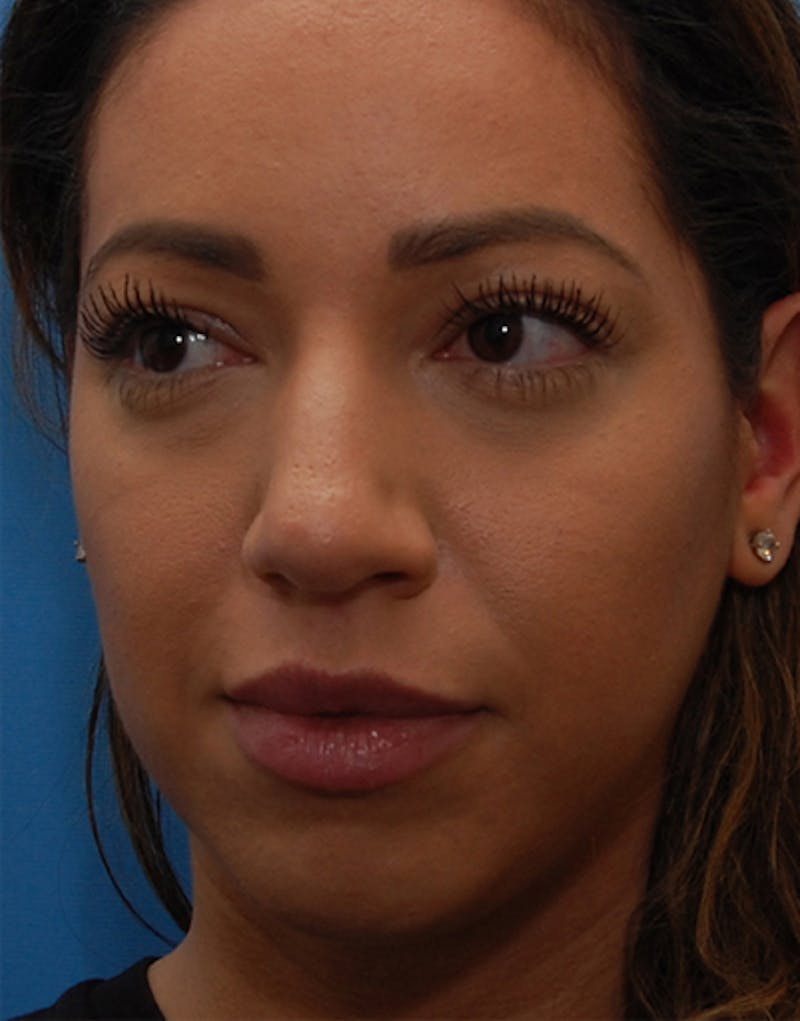 Rhinoplasty Before & After Gallery - Patient 124827 - Image 5