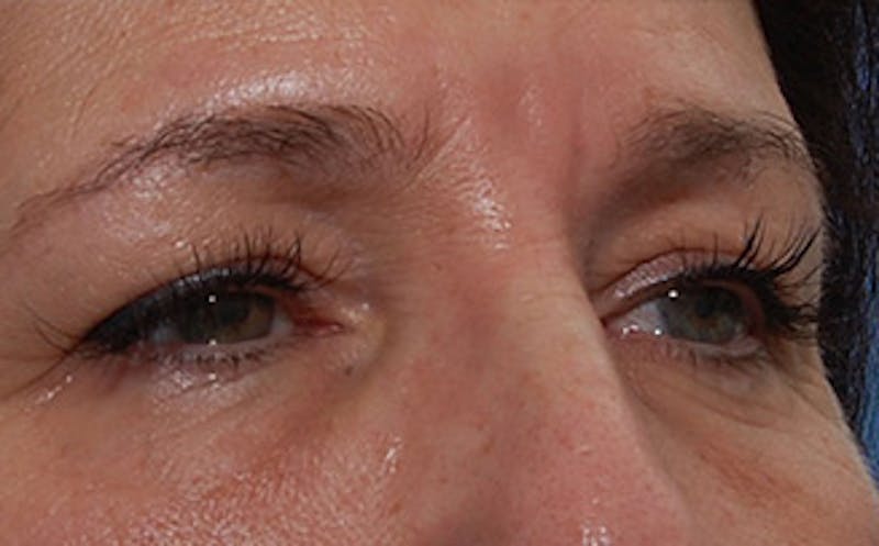 Brow Lift Before & After Gallery - Patient 104505 - Image 3