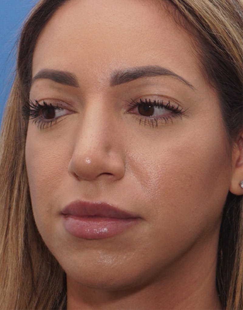 Favorite Ethnic Rhinoplasty Before & After Gallery - Patient 118498 - Image 8