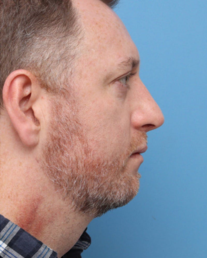Chin Surgery Before & After Gallery - Patient 261927 - Image 2
