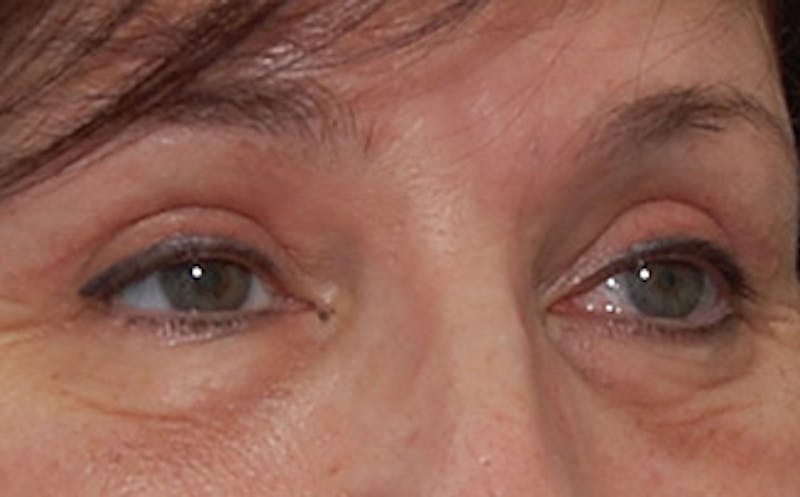 Brow Lift Before & After Gallery - Patient 104505 - Image 4