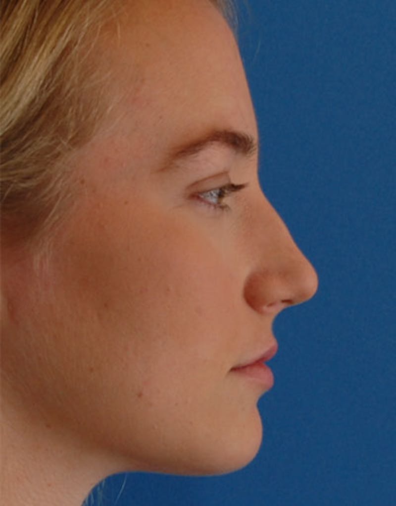 Patient CCB260WTSta9vPaskiobHA - Rhinoplasty Before & After Photos