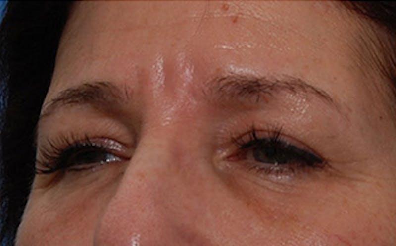 Brow Lift Before & After Gallery - Patient 104505 - Image 5