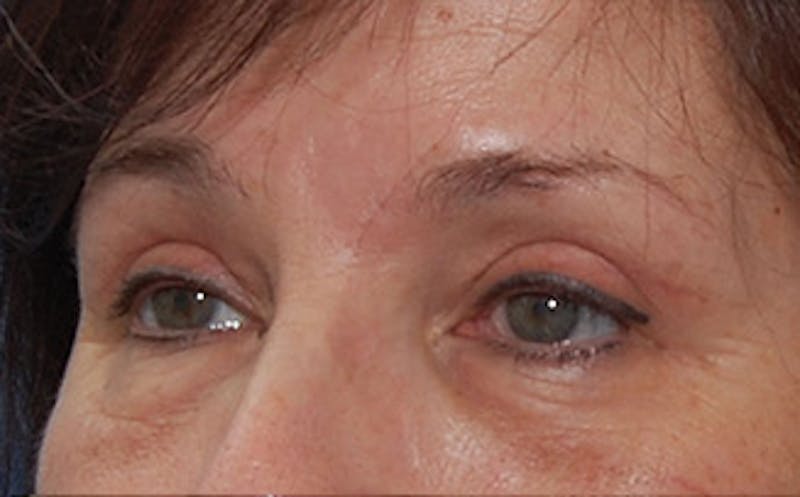 Brow Lift Before & After Gallery - Patient 104505 - Image 6