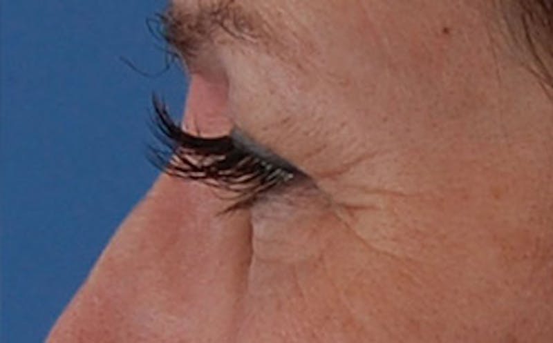 Brow Lift Before & After Gallery - Patient 104505 - Image 7
