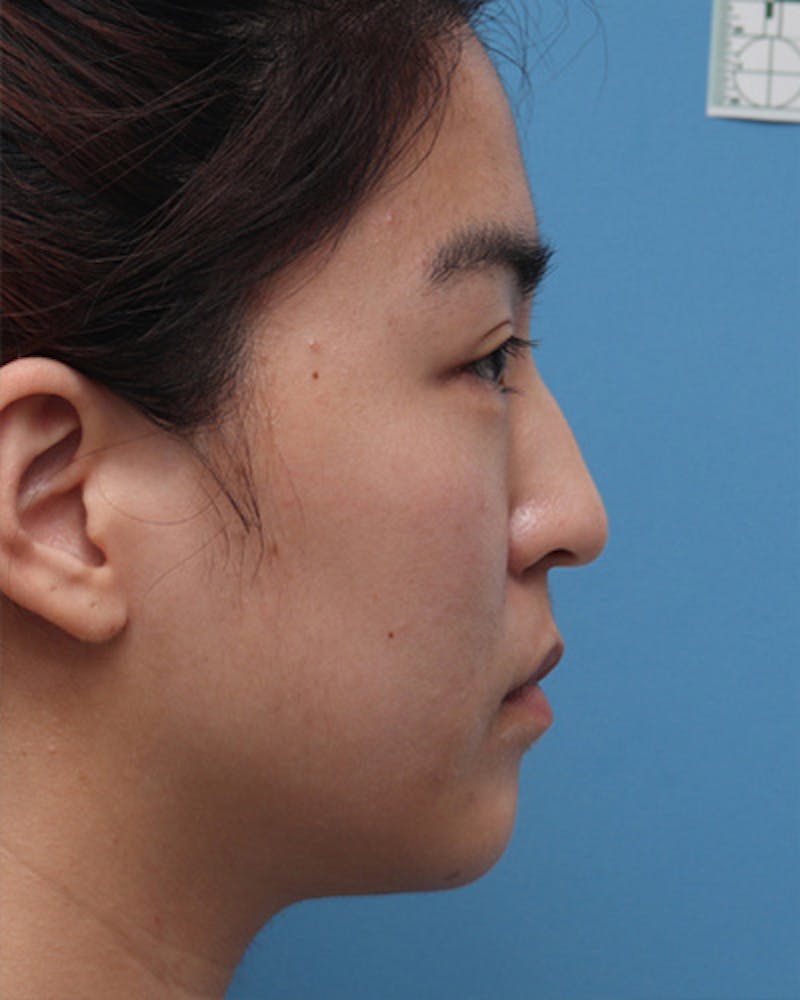 Patient QWehQWPJRvyt352tYFQPCg - Chin Surgery Before & After Photos