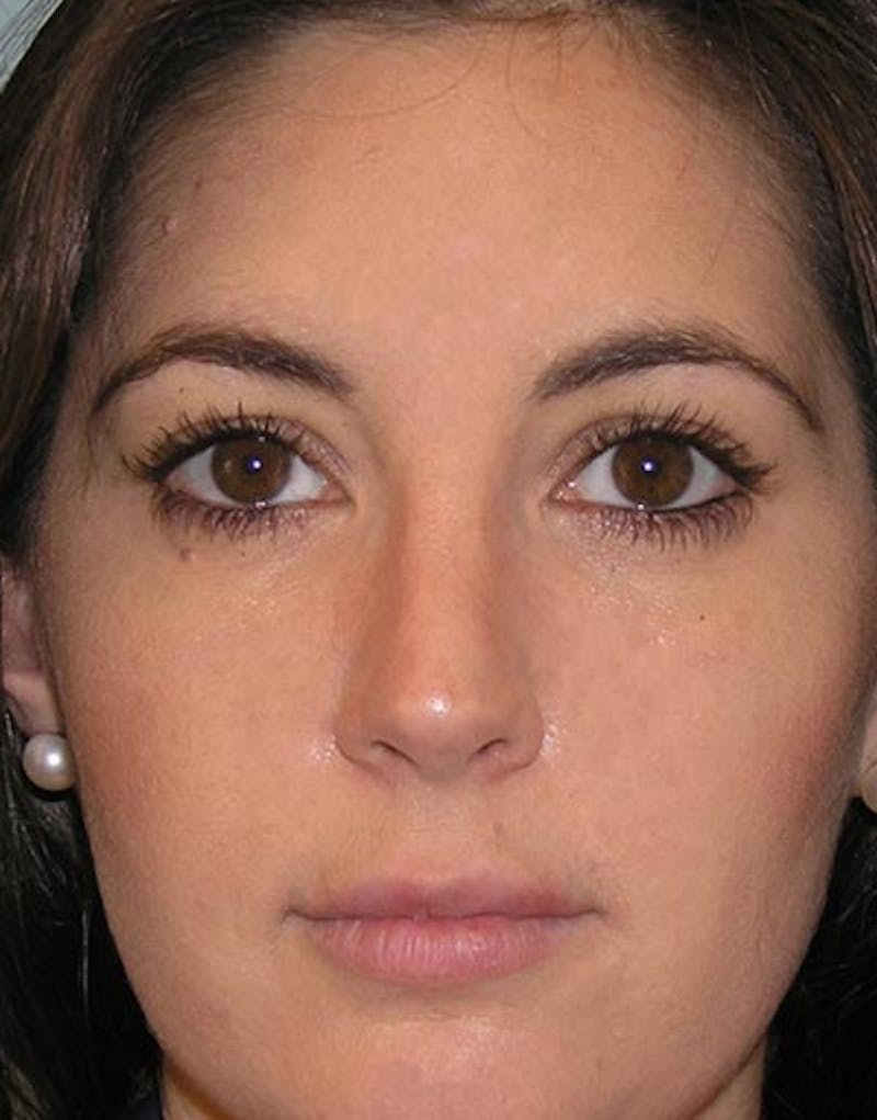 Rhinoplasty Before & After Gallery - Patient 190880 - Image 4