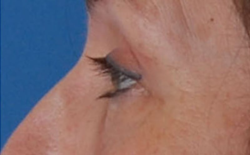 Brow Lift Before & After Gallery - Patient 104505 - Image 8