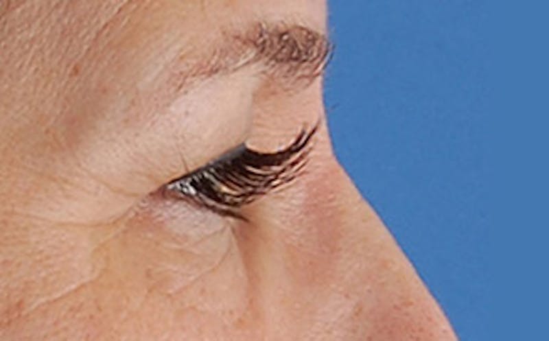 Brow Lift Before & After Gallery - Patient 104505 - Image 9