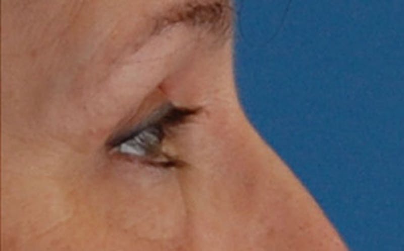 Brow Lift Before & After Gallery - Patient 104505 - Image 10