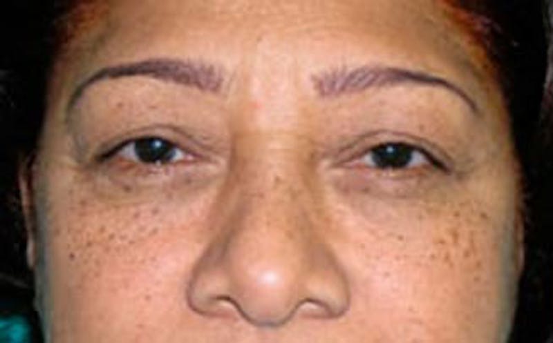 Brow Lift Before & After Gallery - Patient 321376 - Image 1
